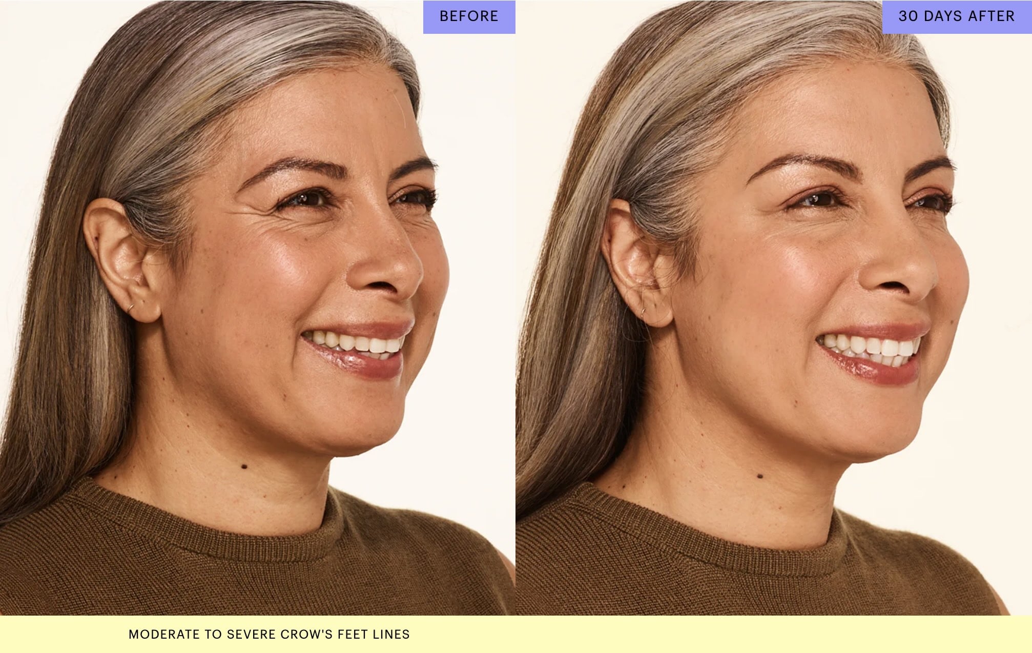 Botox for Crows Feet Before and After