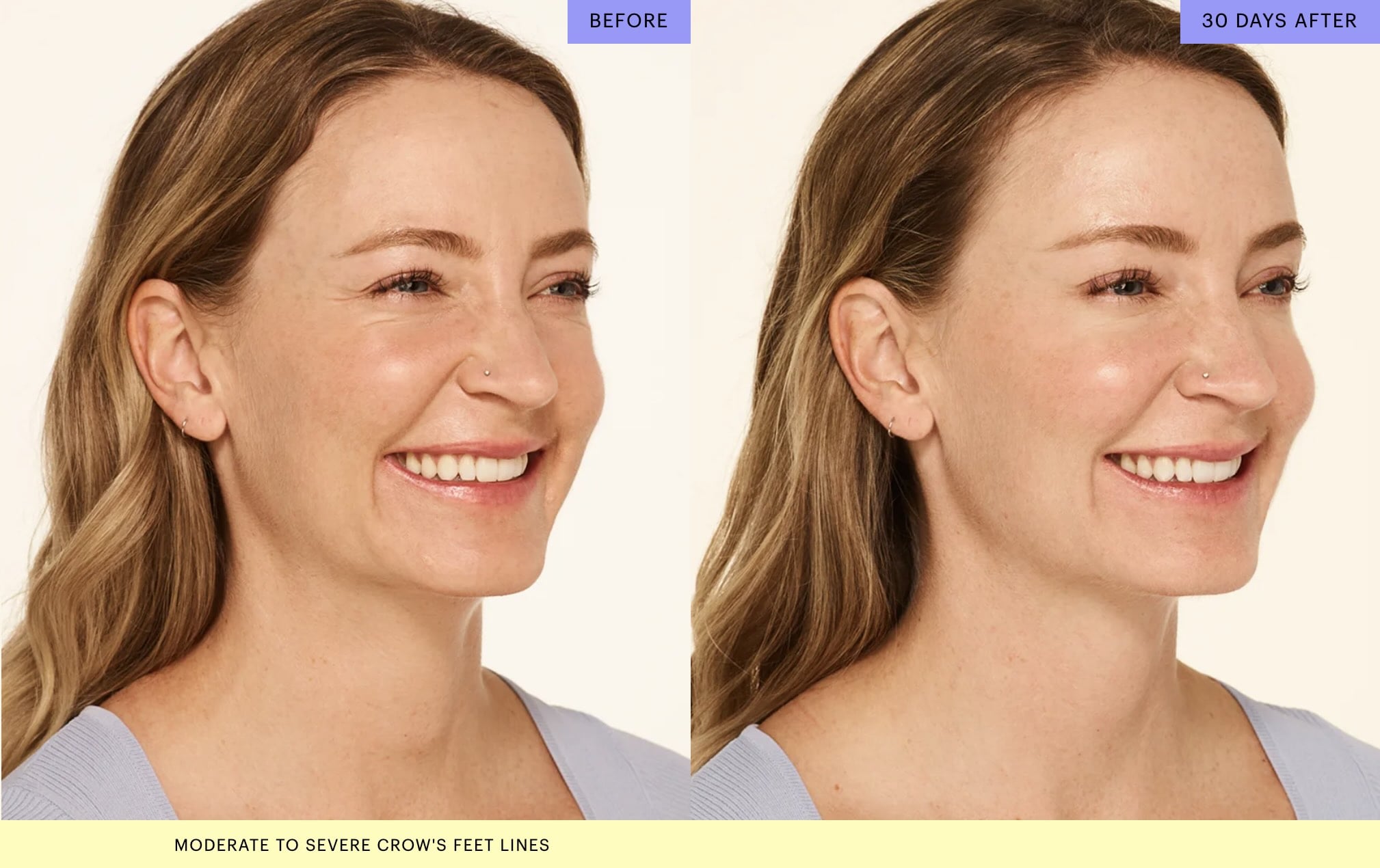 Botox in Palm Beach Gardens for Women - Crows Feet Before and After
