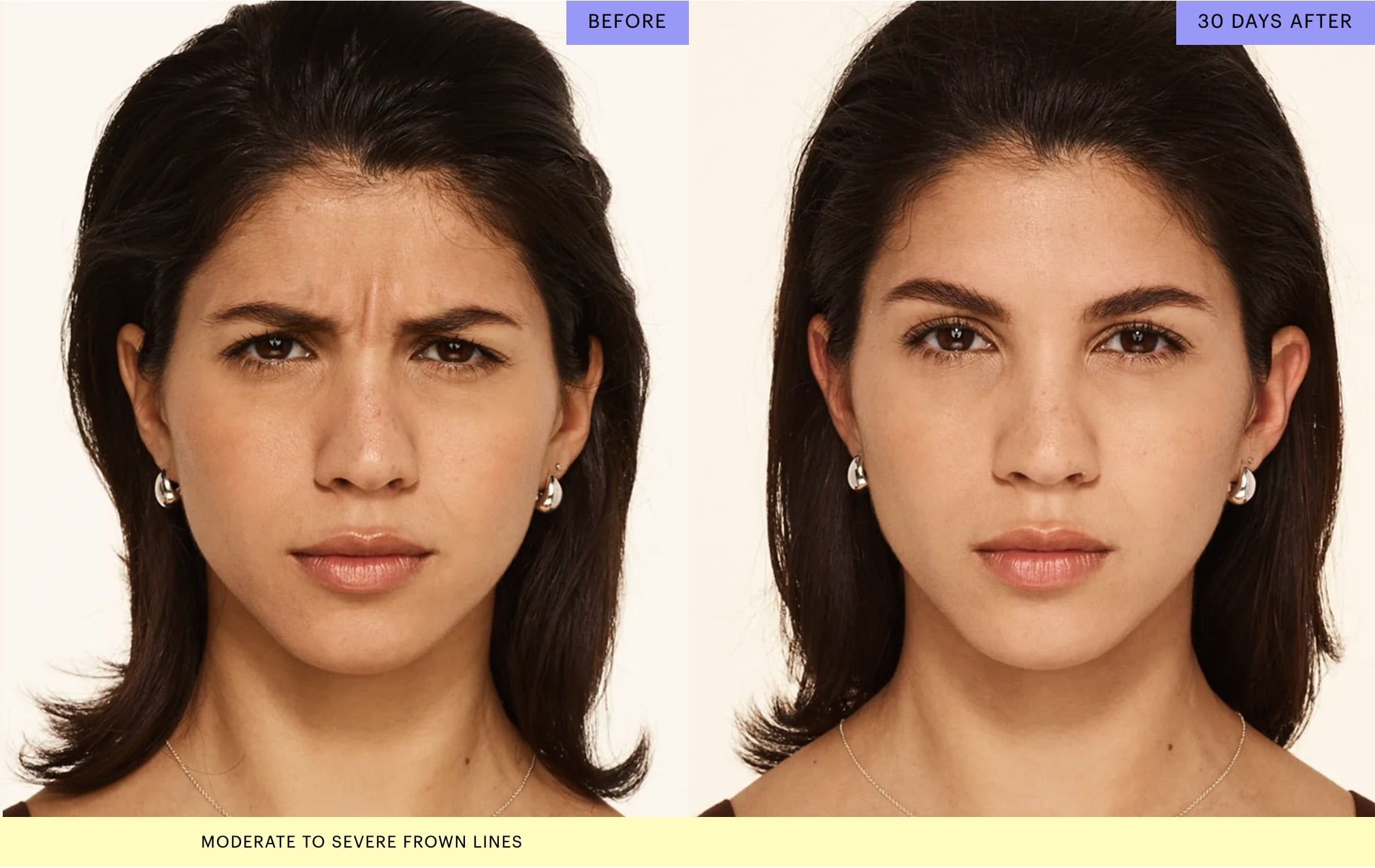 Botox in Palm Beach Gardens for Women - Frown Lines Before and After