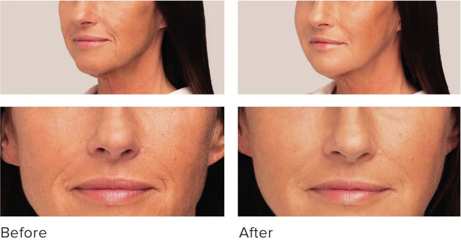 Dermal Fillers Belotero Balance Before and After Woman