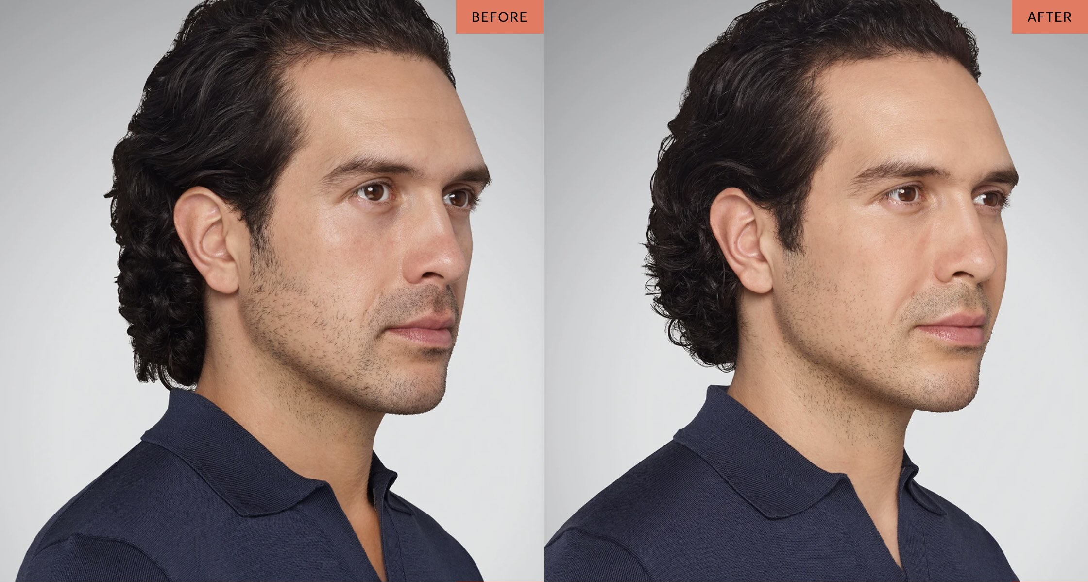 Dermal Fillers for Men Before and After