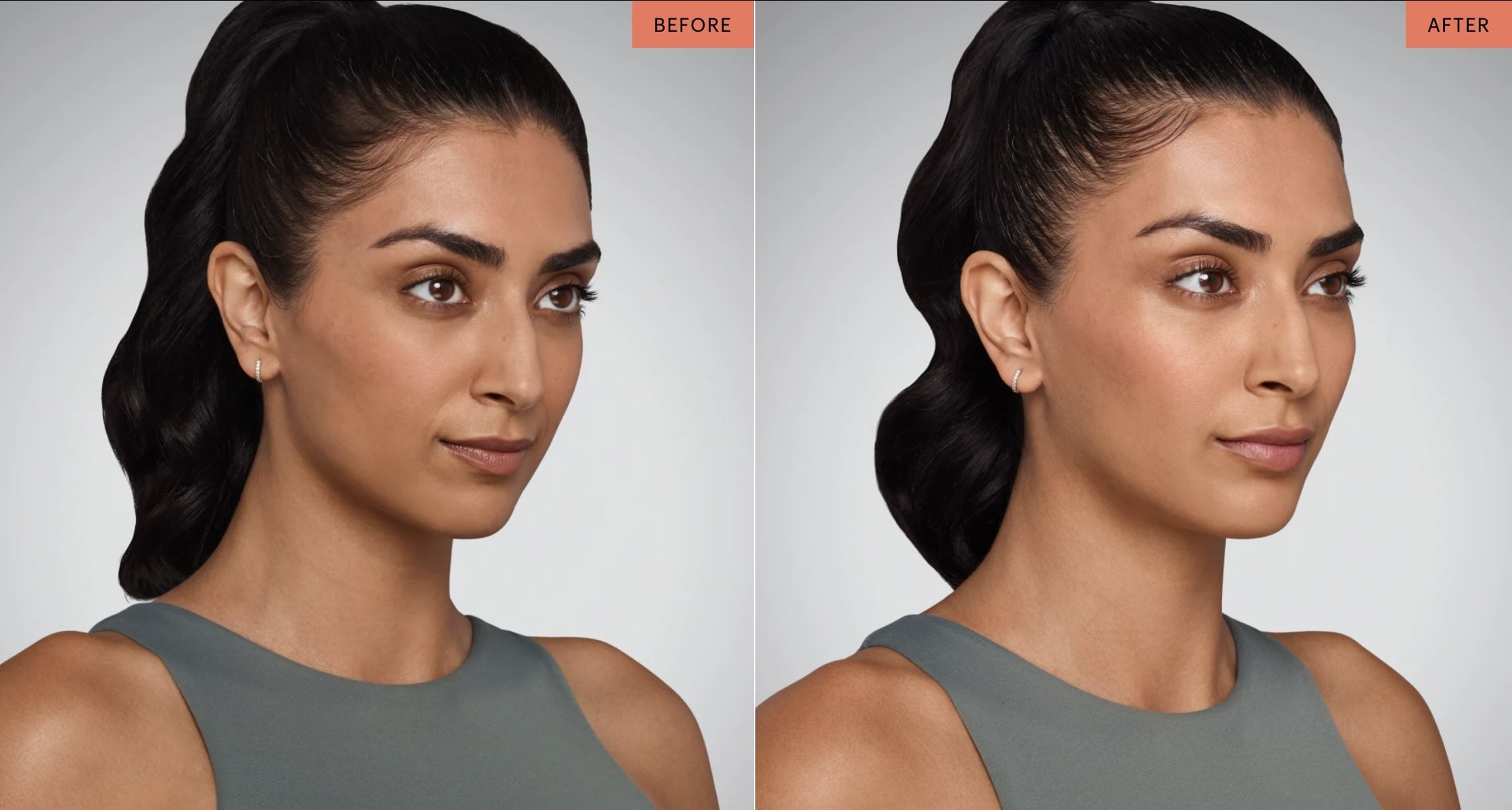 Dermal Fillers in Palm Beach Gardens - Juvederm Before and After - Woman