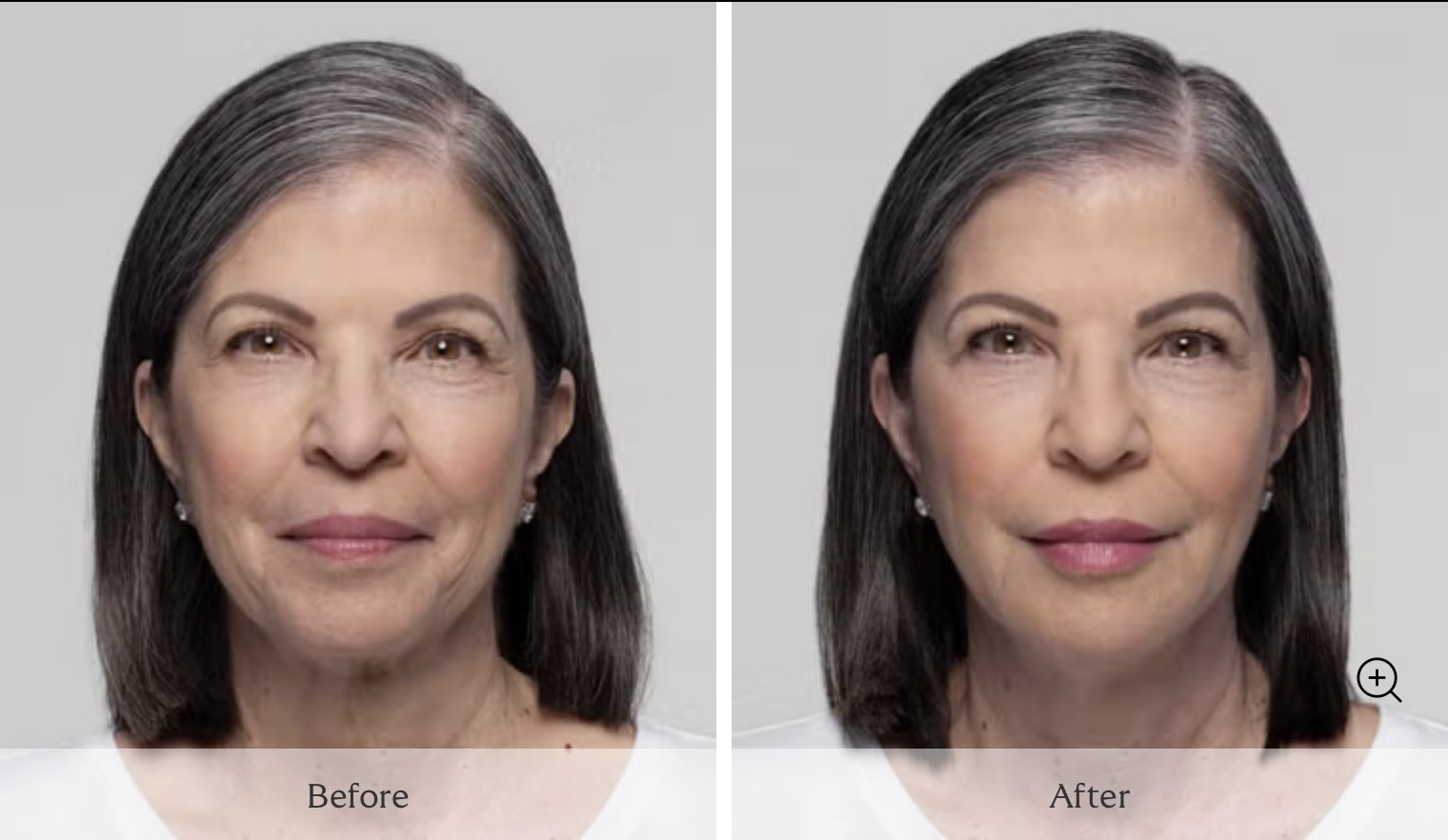 Dermal Fillers in Palm Beach Gardens - Before and After Photo - Restylane - Woman