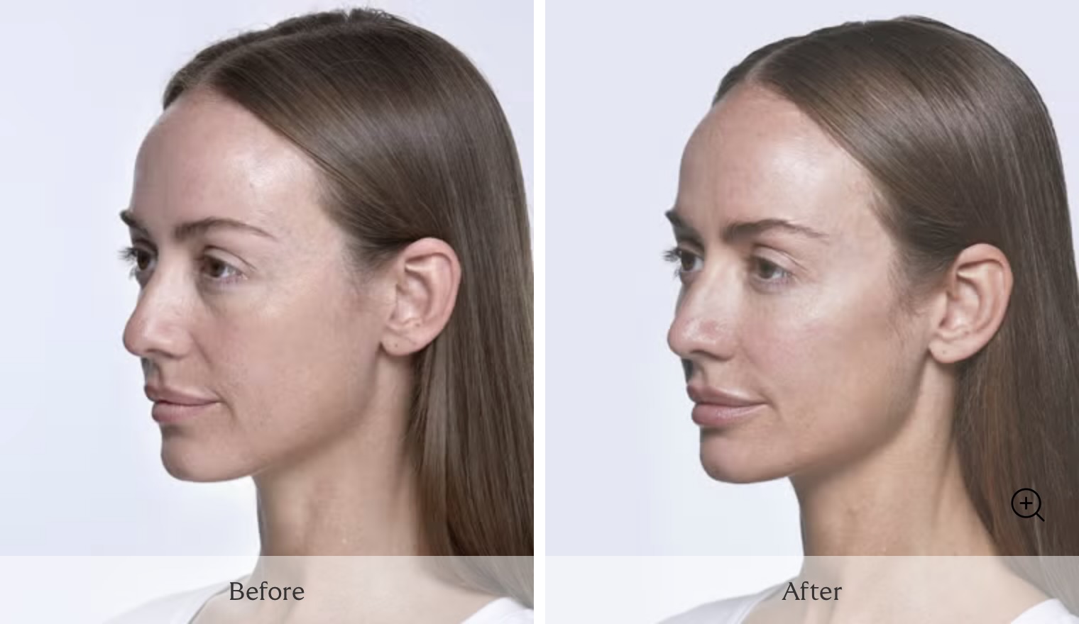 Dermal Fillers in Palm Beach Gardens - Restylane - Before and After - Woman