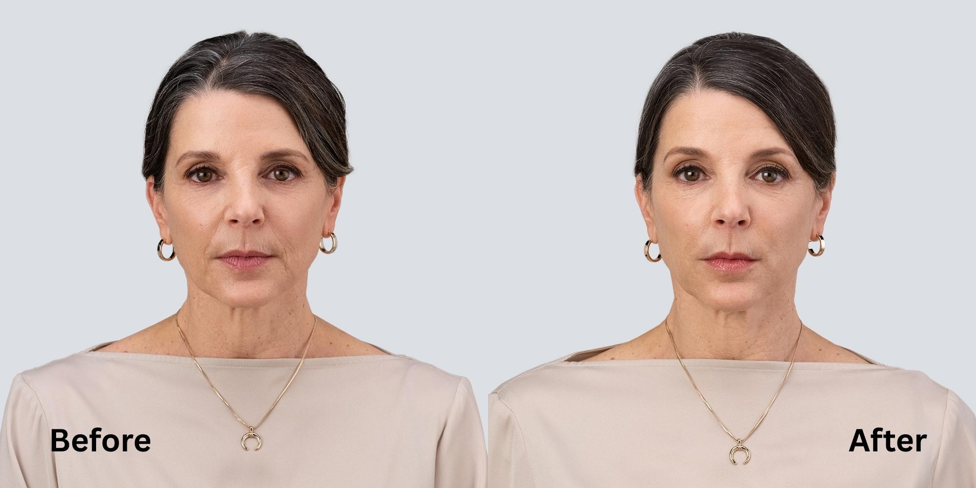 Dermal Fillers RHA Before and After Woman