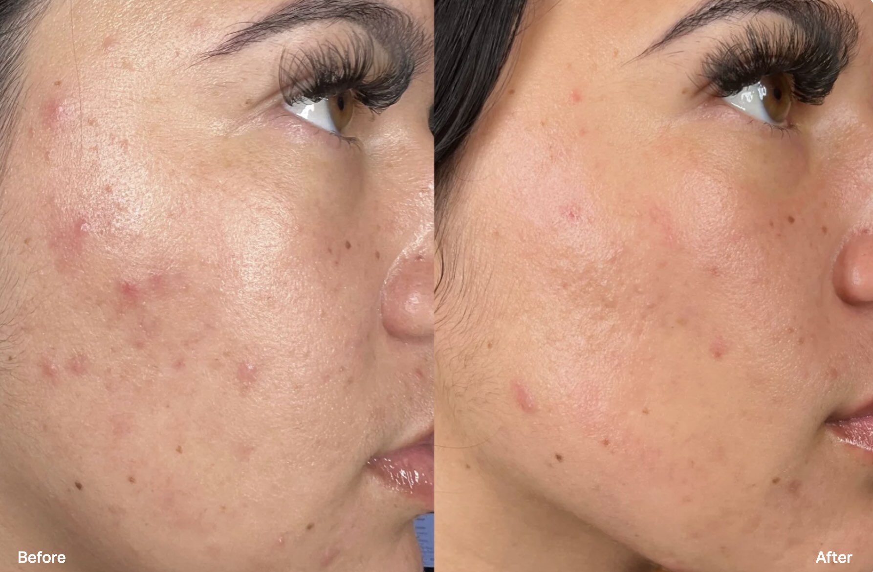 Facials - HydraFacial - Clarifying - Before and After