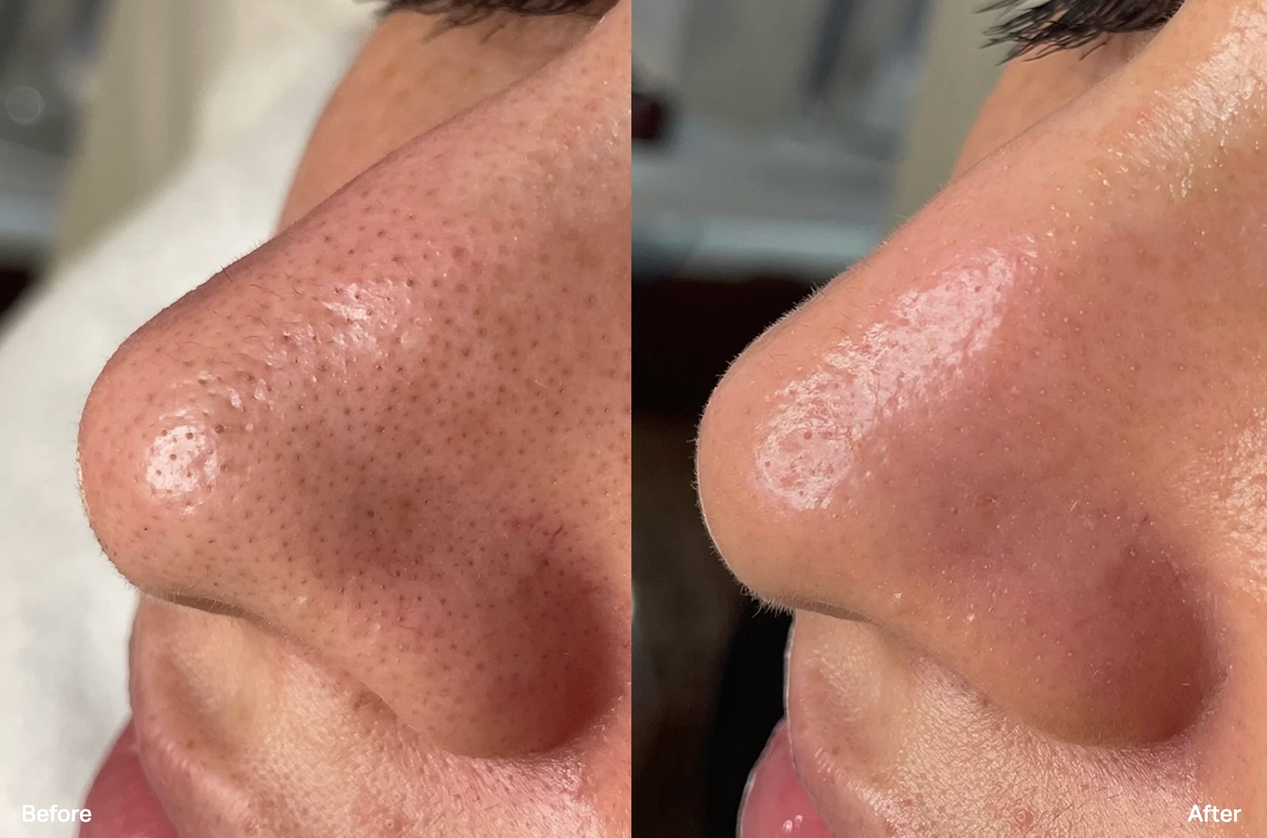 Facials in Palm Beach Gardens - HydraFacial - Pores Before and After