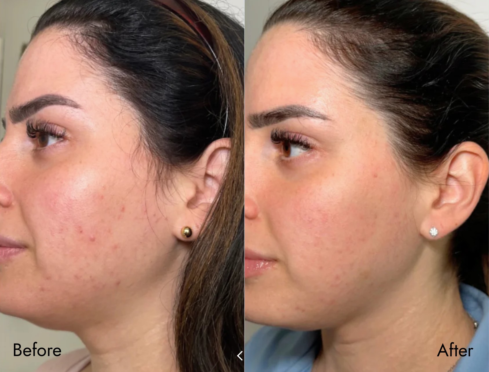 Facials - PRX Derm Perfexion - Before and After